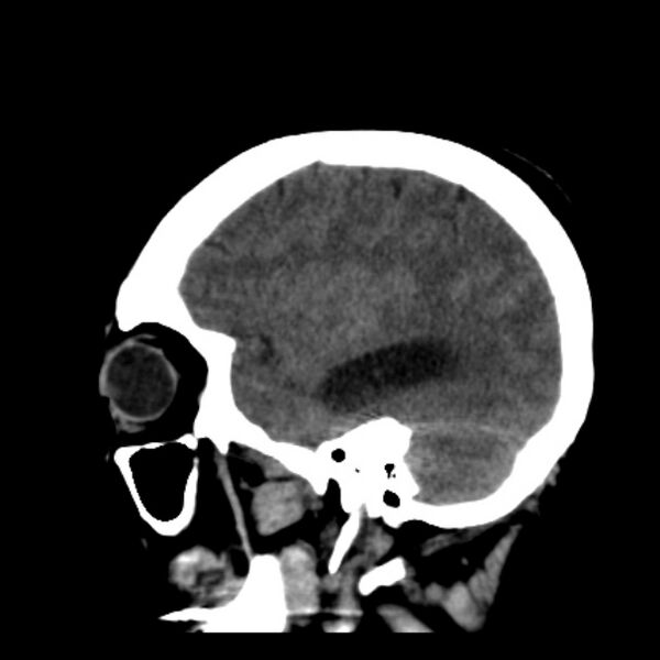 File:Cerebellar hemorrhage causing obstructive hydrocephalus (Radiopaedia 33989-35207 B 36).jpg