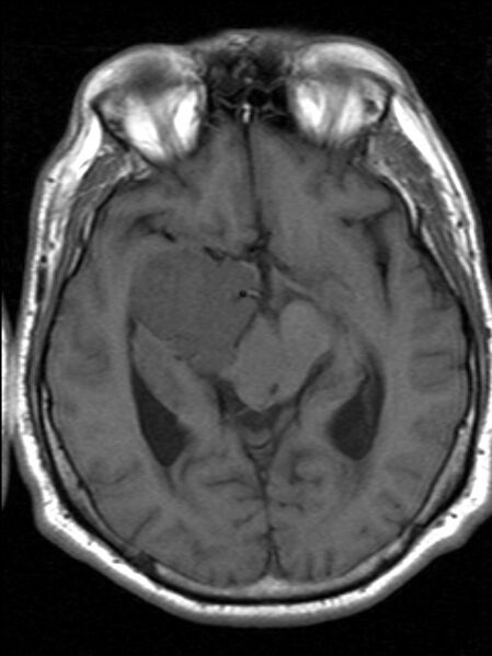 File:Cerebellopontine angle meningioma (Radiopaedia 24459-24764 Axial T1 10).jpg