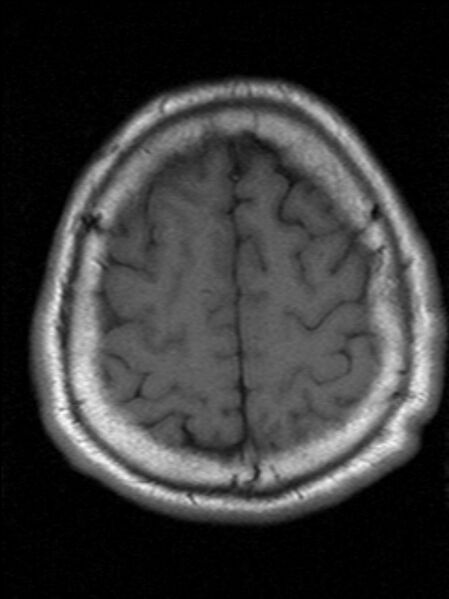 File:Cerebellopontine angle meningioma (Radiopaedia 24459-24764 Axial T1 20).jpg