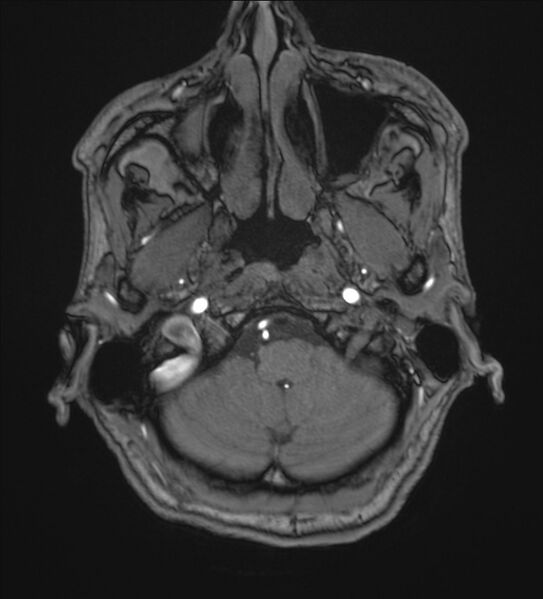File:Cerebellopontine angle meningioma (Radiopaedia 72983-83680 Axial MRA 8).jpg