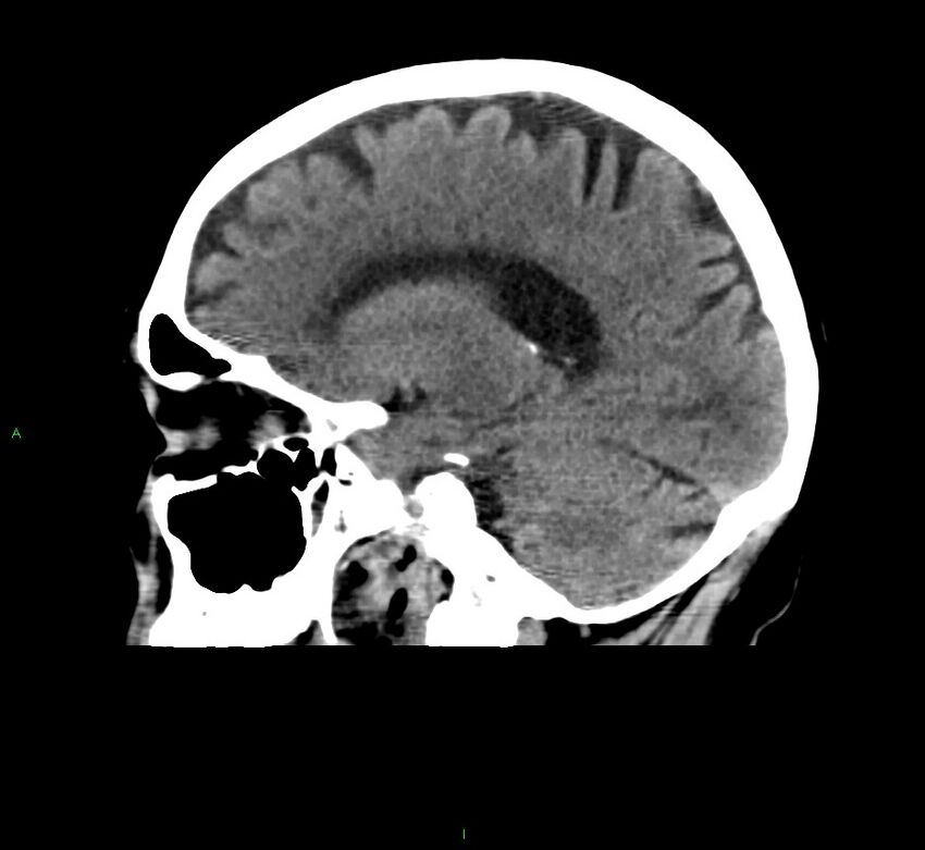 Cerebral amyloid angiopathy-associated lobar intracerebral hemorrhage (Radiopaedia 58376-65511 C 21).jpg