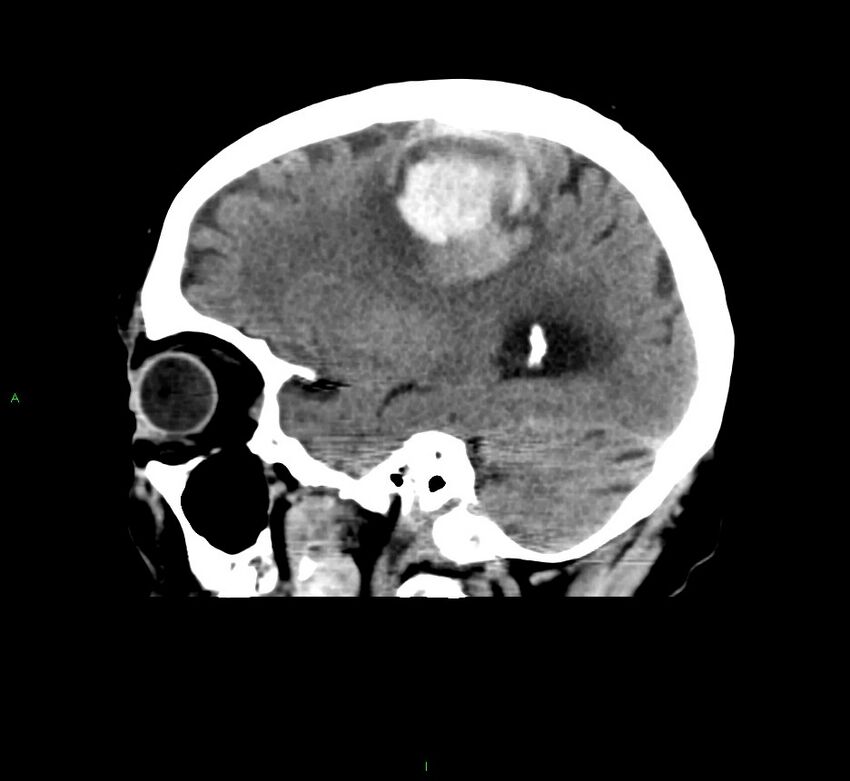 Cerebral amyloid angiopathy-associated lobar intracerebral hemorrhage (Radiopaedia 58376-65511 C 37).jpg