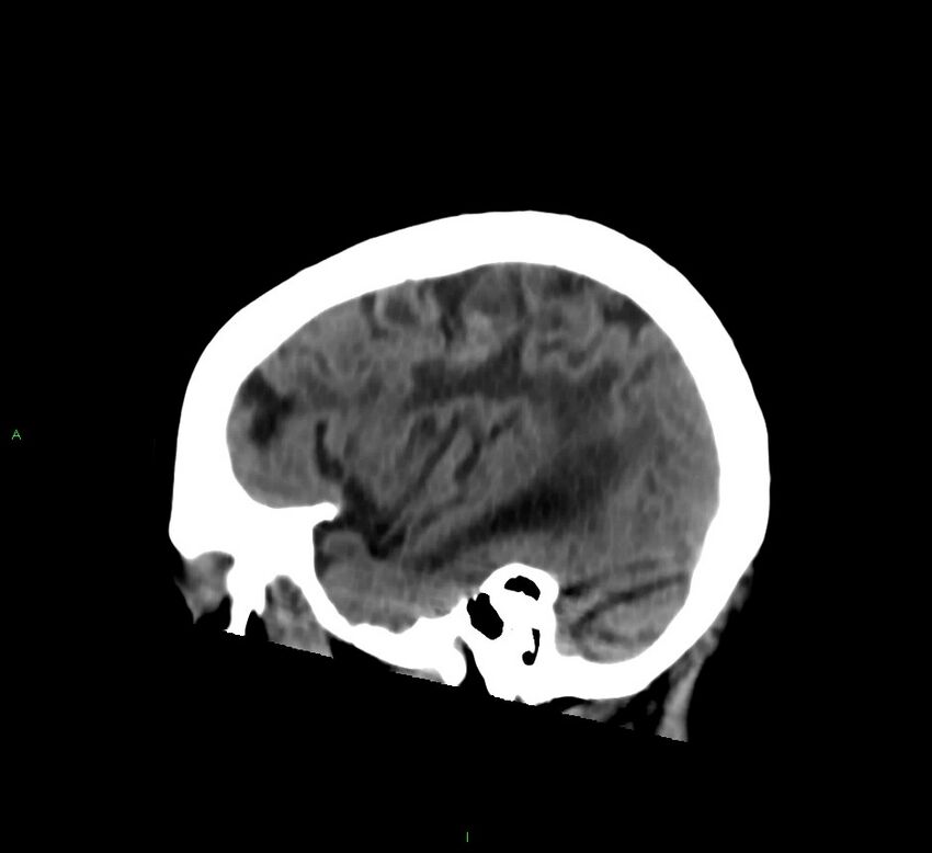 Cerebral amyloid angiopathy-associated lobar intracerebral hemorrhage (Radiopaedia 58376-65513 C 52).jpg