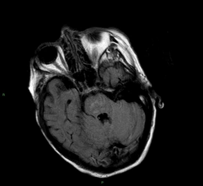 File:Cerebral amyloid angiopathy-associated lobar intracerebral hemorrhage (Radiopaedia 58377-65515 Axial FLAIR 19).jpg