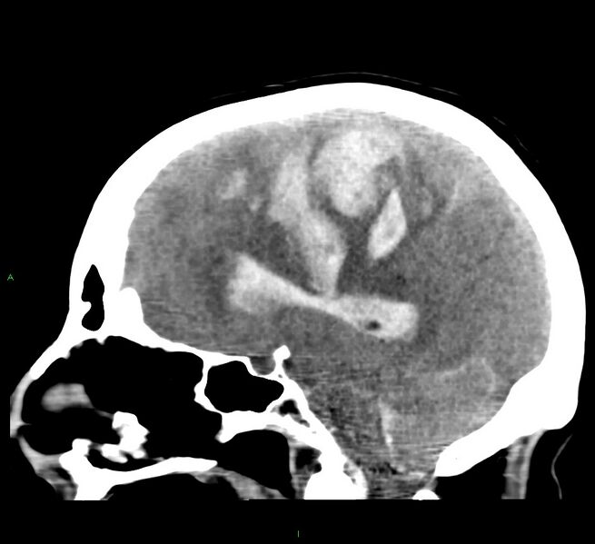File:Cerebral amyloid angiopathy-associated lobar intracerebral hemorrhage (Radiopaedia 58379-65519 C 27).jpg