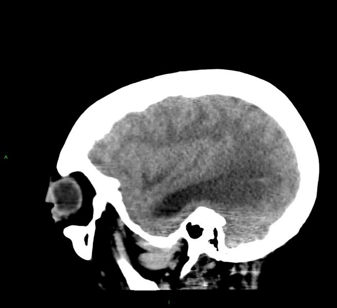 File:Cerebral amyloid angiopathy-associated lobar intracerebral hemorrhage (Radiopaedia 58379-65519 C 41).jpg