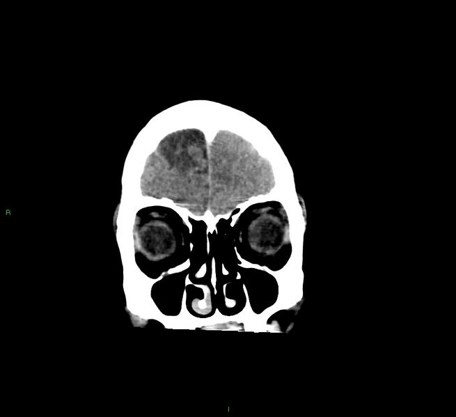 File:Cerebral amyloid angiopathy-associated lobar intracerebral hemorrhage (Radiopaedia 58529-65681 Coronal non-contrast 56).jpg