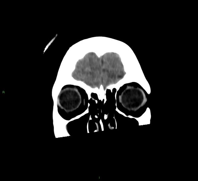 File:Cerebral amyloid angiopathy-associated lobar intracerebral hemorrhage (Radiopaedia 58566-65730 Coronal non-contrast 59).jpg