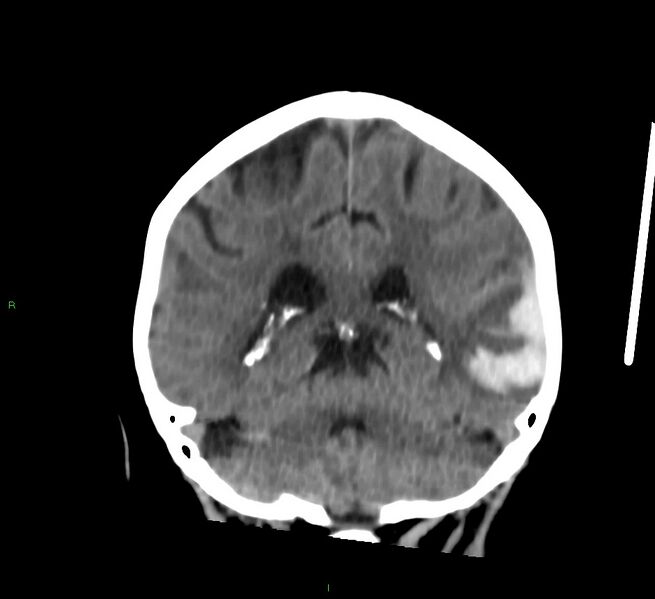 File:Cerebral amyloid angiopathy-associated lobar intracerebral hemorrhage (Radiopaedia 58757-65978 Coronal non-contrast 26).jpg