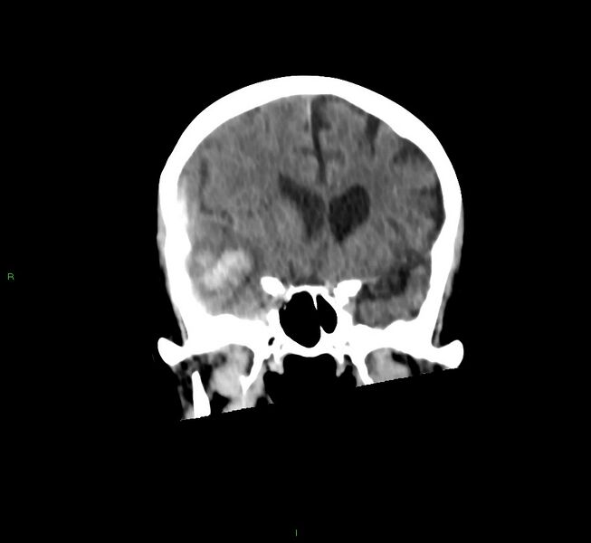 File:Cerebral amyloid angiopathy-associated lobar intracerebral hemorrhage (Radiopaedia 58758-65980 Coronal non-contrast 42).jpg