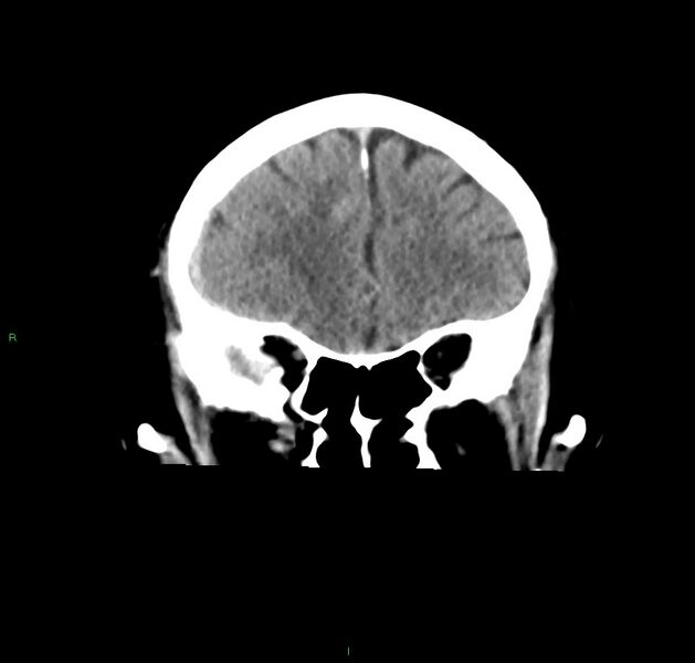 File:Cerebral amyloid angiopathy-associated lobar intracerebral hemorrhage (Radiopaedia 59356-66716 Coronal non-contrast 48).jpg