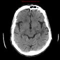 Cerebral and orbital tuberculomas (Radiopaedia 13308-13310 Axial non-contrast 31).jpg