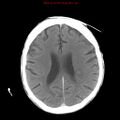 Cerebral and orbital tuberculomas (Radiopaedia 13308-13310 B 19).jpg