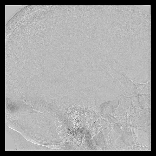 File:Cerebral aneurysm with rupture (Radiopaedia 29933-30458 LT CCA IC 52).jpg