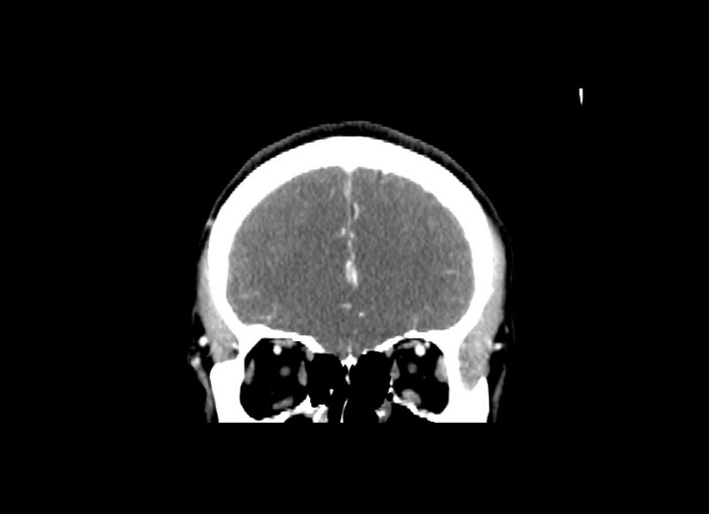 File:Cerebral edema (Radiopaedia 82519-96661 C 48).jpg