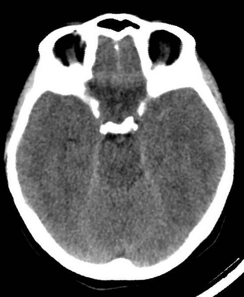 File:Cerebral edema due to severe hyponatremia (Radiopaedia 89826-106937 Axial non-contrast 33).jpg