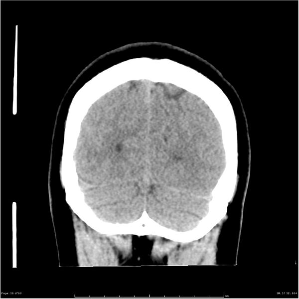 File:Cerebral hemorrhage secondary to arteriovenous malformation (Radiopaedia 33497-34561 Coronal non-contrast 47).jpg