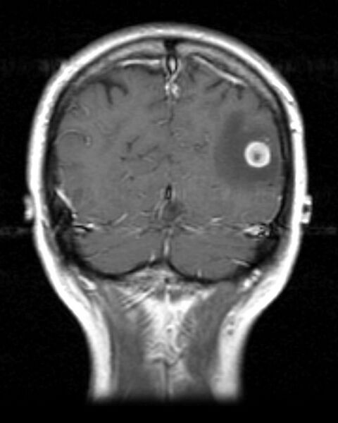File:Cerebral metastasis - Bull's eye sign (Radiopaedia 2588-6283 Coronal T1 C+ 1).jpg