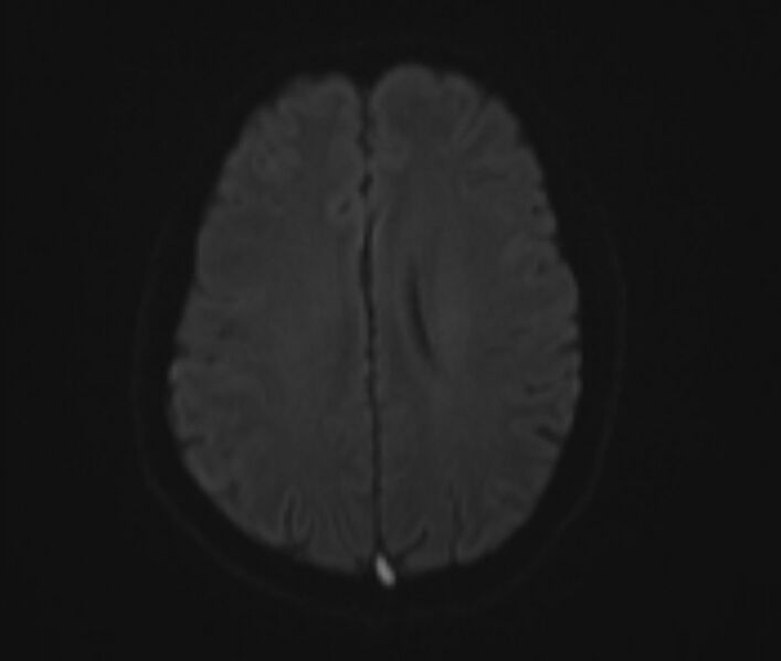 File:Cerebral venous thrombosis (Radiopaedia 71207-81504 Axial DWI 13).jpg