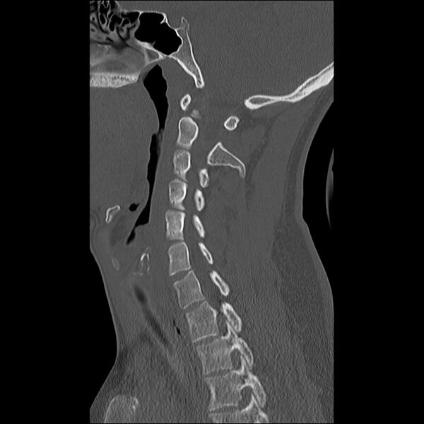 File:Cervical facet fracture and anterior discoligamentous injury (Radiopaedia 32139-33083 Sagittal bone window 23).jpg