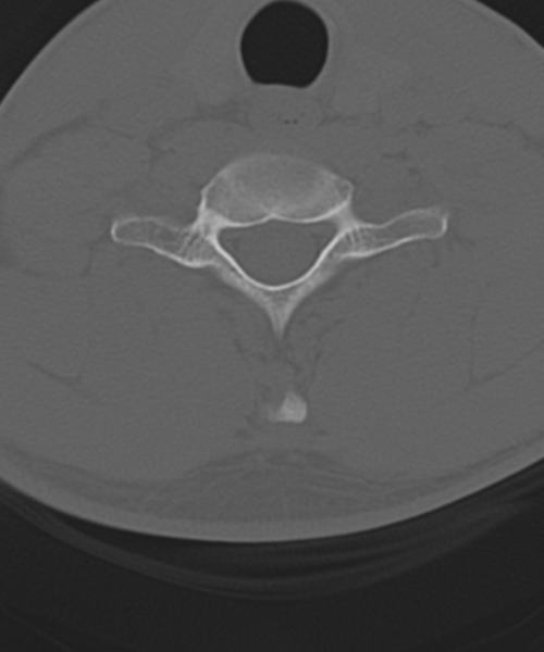 File:Cervical intercalary bone (Radiopaedia 35211-36748 Axial bone window 49).png
