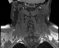 Cervical schwannoma (Radiopaedia 72399-82934 G 12).jpg