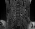 Cervical schwannoma (Radiopaedia 72399-82934 G 4).jpg