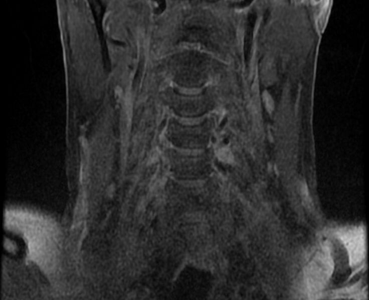 File:Cervical schwannoma (Radiopaedia 72399-82934 G 4).jpg