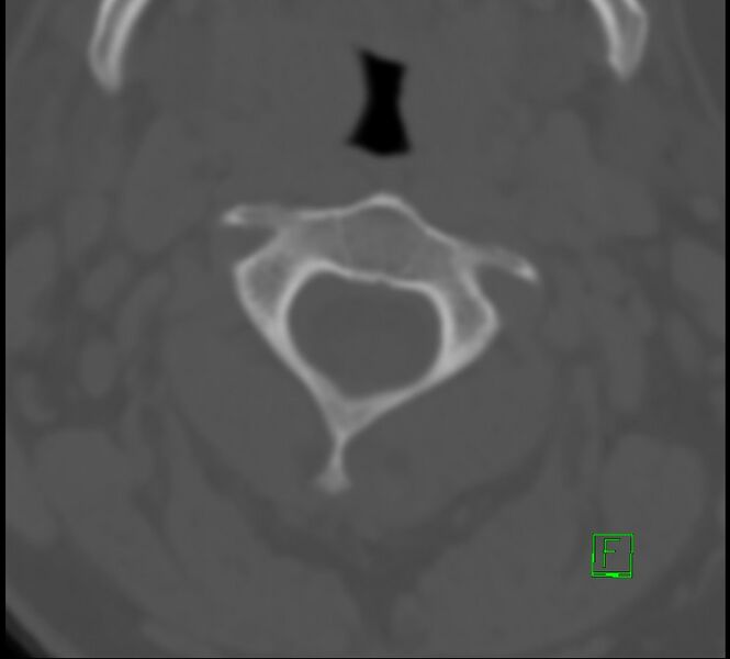 File:Cervical spine fracture - hyperflexion injury (Radiopaedia 66184-75364 Axial bone window 7).jpg