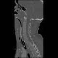 Cervical spine fractures with vertebral artery dissection (Radiopaedia 32135-33078 Sagittal bone window 20).jpg