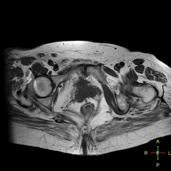 File:Cervical stump squamous cell carcinoma (Radiopaedia 48049-52858 Axial T1 5).jpg