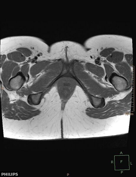 File:Cesarian scar endometriosis (Radiopaedia 68495-78066 Axial T1 26).jpg