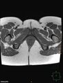 Cesarian scar endometriosis (Radiopaedia 68495-78066 Axial T1 26).jpg
