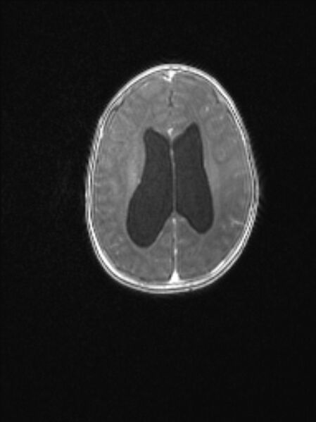 File:Chiari III malformation with occipital encephalocele (Radiopaedia 79446-92559 Axial T1 C+ mpr 60).jpg