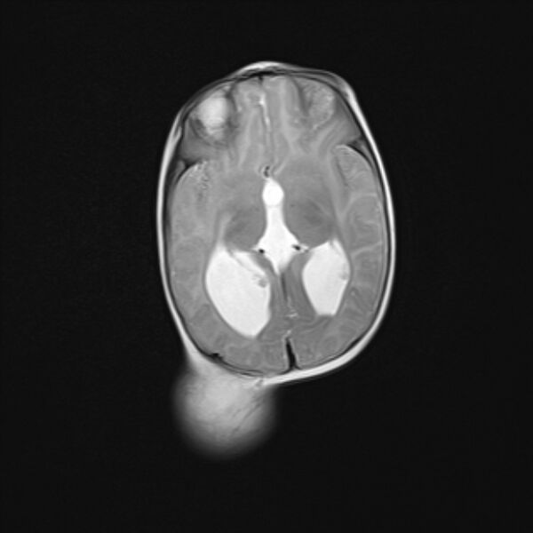File:Chiari III malformation with occipital encephalocele (Radiopaedia 79446-92559 Axial T2 15).jpg