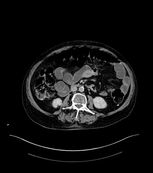 File:Cholangiocarcinoma with cerebral metastases (Radiopaedia 83519-98629 Axial C+ delayed 62).jpg