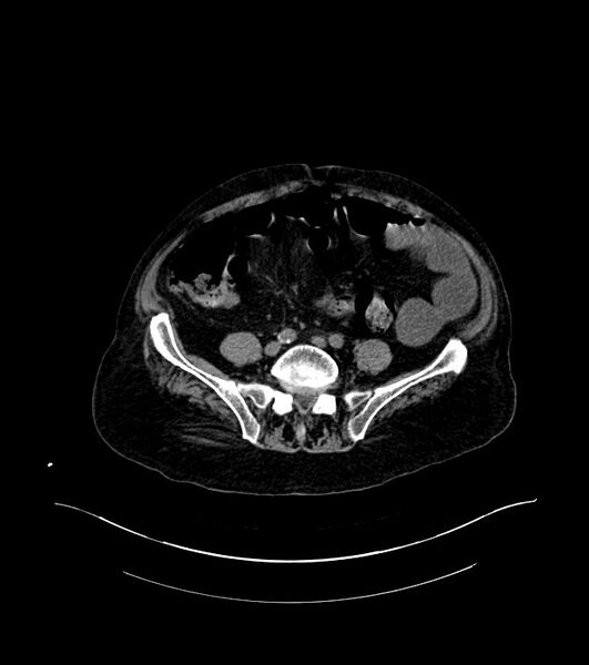 File:Cholangiocarcinoma with cerebral metastases (Radiopaedia 83519-98629 Axial non-contrast 85).jpg
