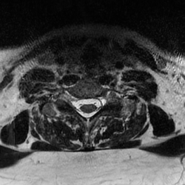 File:Chordoma - cervical spine (Radiopaedia 70084-80111 Axial T2 75).png