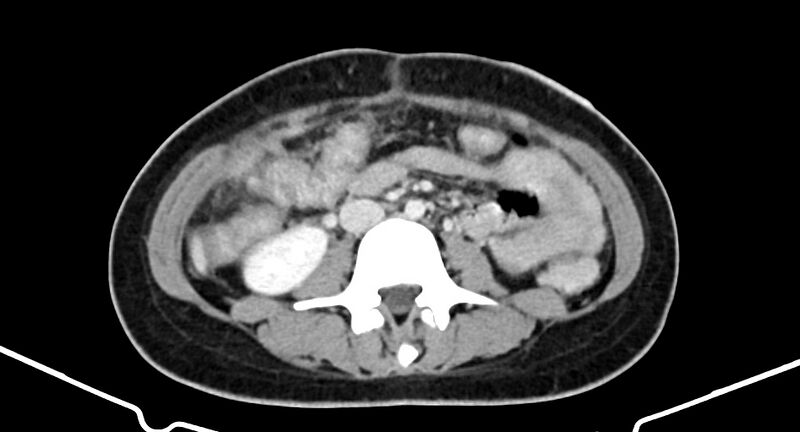 File:Choriocarcinoma liver metastases (Radiopaedia 74768-85766 A 117).jpg
