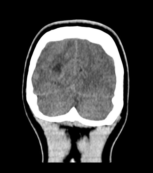 File:Choroid plexus carcinoma (Radiopaedia 91013-108552 Coronal non-contrast 76).jpg