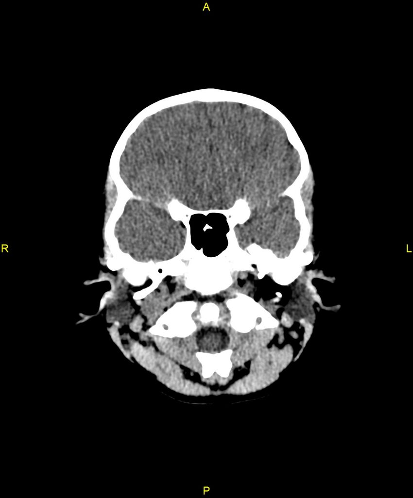 Choroidal fissure cyst (Radiopaedia 89481-106465 Axial non-contrast 27).jpg