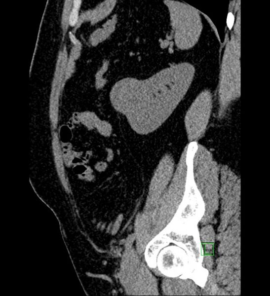 File:Chromophobe renal cell carcinoma (Radiopaedia 84286-99573 C 42).jpg