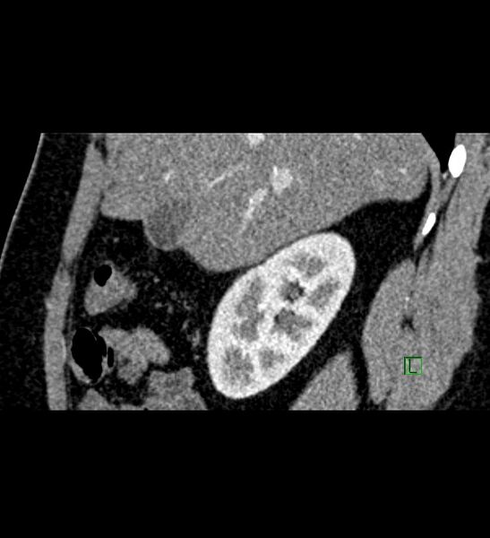 File:Chromophobe renal cell carcinoma (Radiopaedia 84286-99573 F 126).jpg