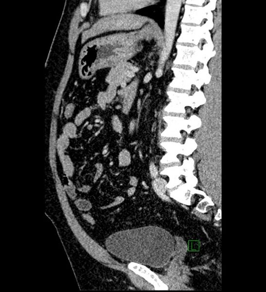 File:Chromophobe renal cell carcinoma (Radiopaedia 84286-99573 I 78).jpg