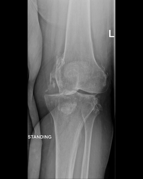 File:Chronic knee dislocation (Radiopaedia 64998-73962 Frontal 1).jpg