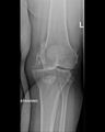 Chronic knee dislocation (Radiopaedia 64998-73962 Frontal 1).jpg