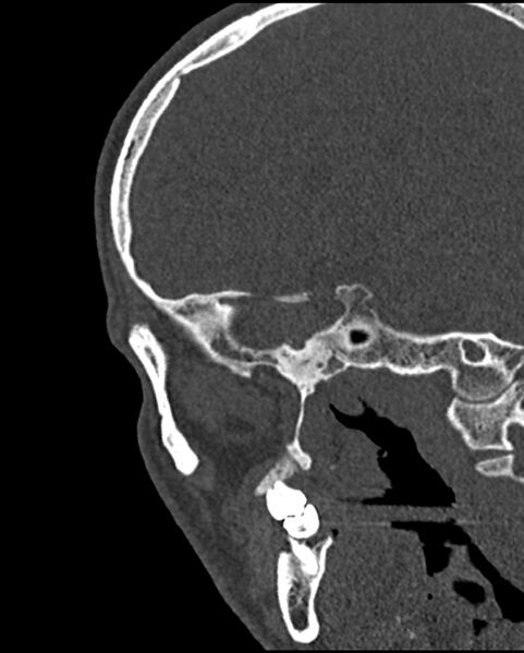 File:Chronic maxillary sinusitis caused by a foreign body (Radiopaedia 58521-65676 Sagittal bone window 65).jpg