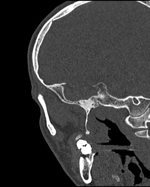 File:Chronic maxillary sinusitis caused by a foreign body (Radiopaedia 58521-65676 Sagittal bone window 69).jpg
