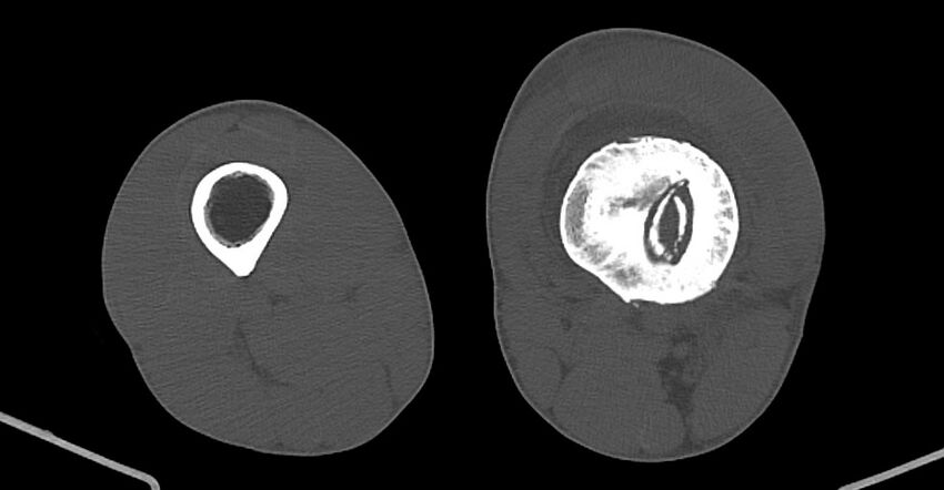 Chronic osteomyelitis (with sequestrum) (Radiopaedia 74813-85822 Axial non-contrast 138).jpg
