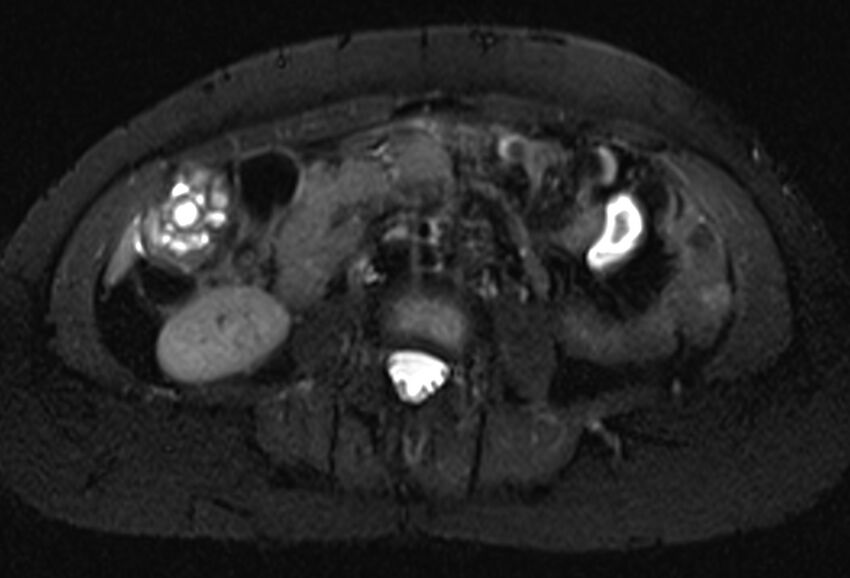 Chronic pancreatitis - pancreatic duct calculi (Radiopaedia 71818-82250 Axial T2 fat sat 44).jpg